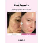 عکس سرم نیاسینامید کوزارکس حجم 20 میل اصلی تاثیرات استفاده قبل و بعد